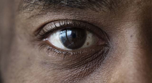 Concerns Mount as Cases of Blindness Surge in Plateau State