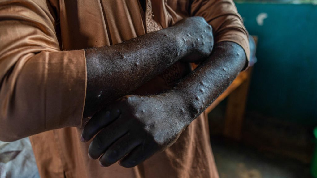 France Confirms First Case of New Mpox Variant