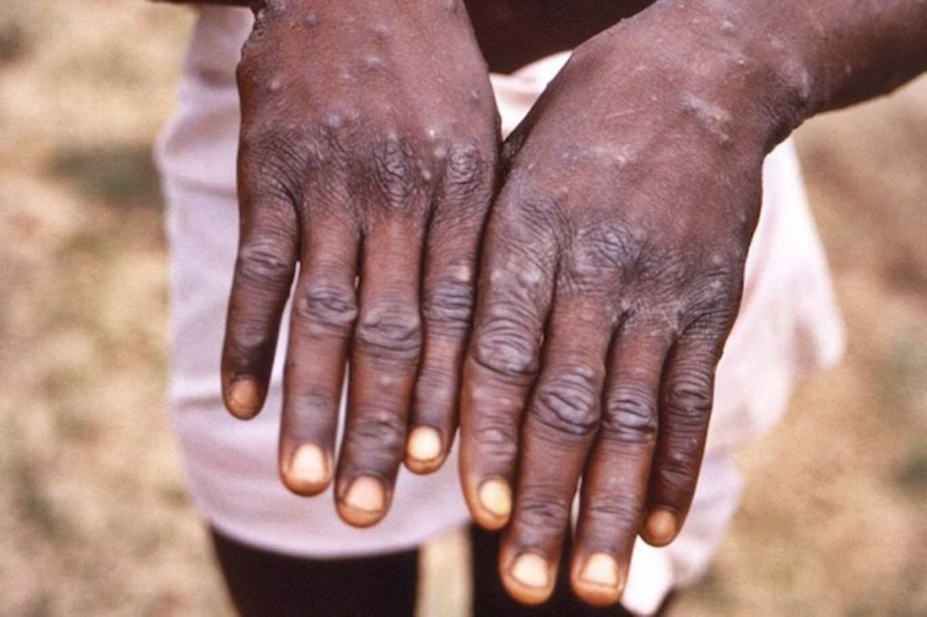 Kenya Reports First Mpox Case Amid Regional Health Concerns