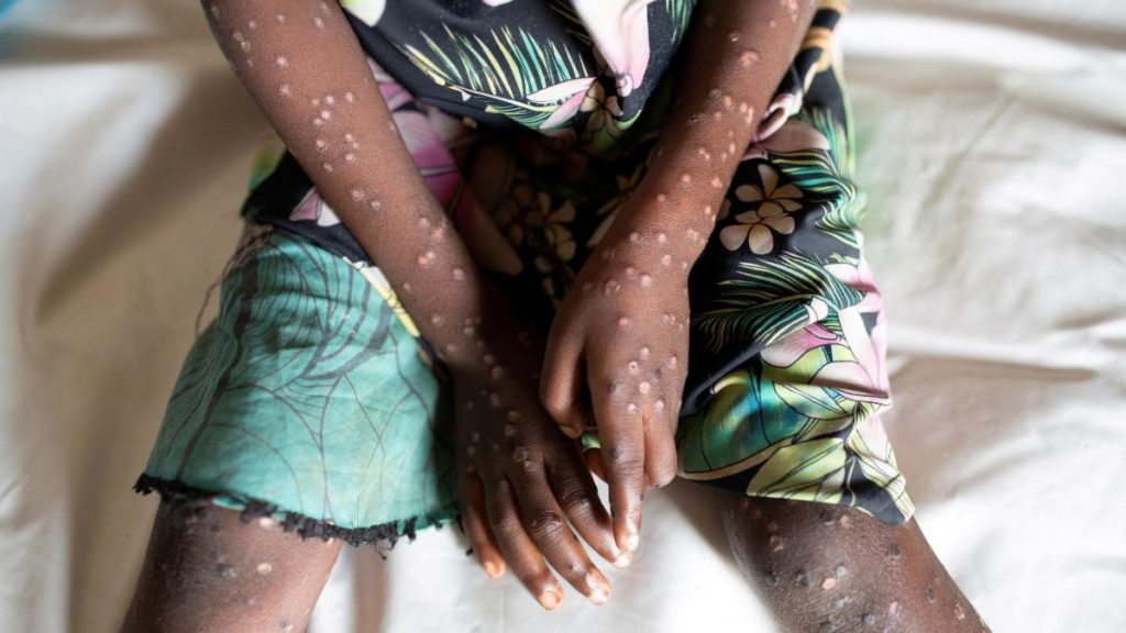 Mpox Outbreak Claims 548 Lives in DR Congo, First Severe Case Recorded in Sweden