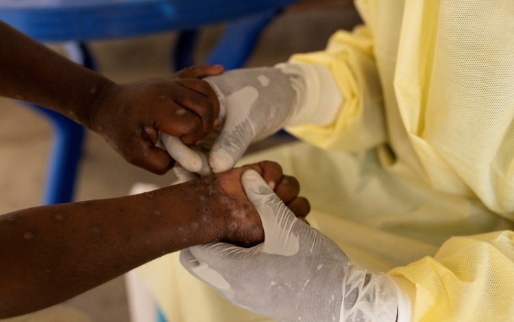 Mpox Surge Prompts Public Health Alert in Sierra Leone