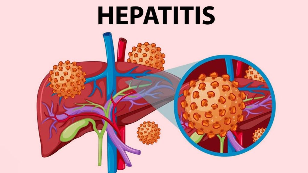 Over 15,000 Ghanaians Died of Hepatitis in 2022