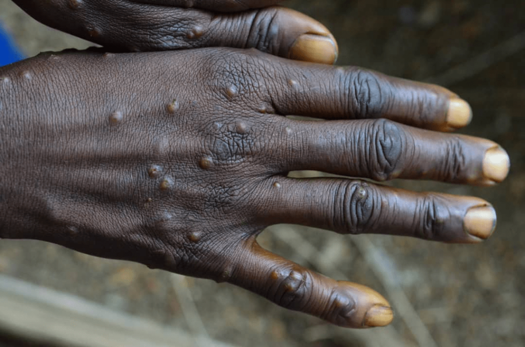 Mpox Epidemic Declared In Congo Republic 