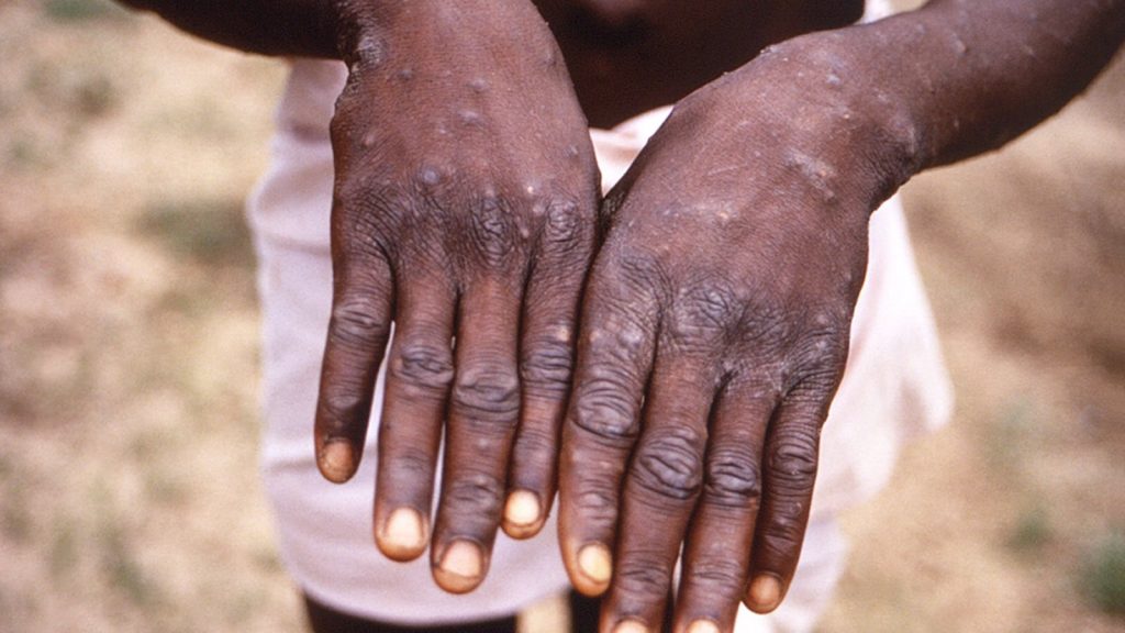 Mpox Epidemic Declared In Congo Republic